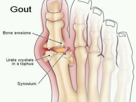 Chế độ ăn Uống, Kiêng Kị Cho Người Bị Mắc Bệnh Gout