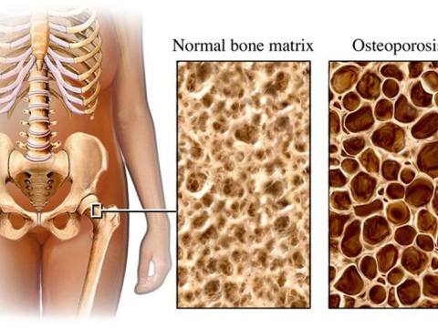 Chế độ ăn Uống, Kiêng Kị Cho Người Bị Mắc Bệnh Loãng Xương