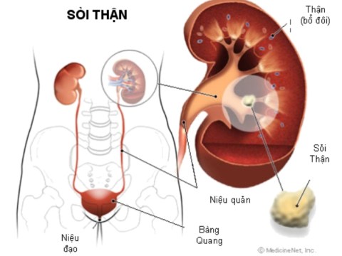 Chế độ ăn Uống, Kiêng Kị Cho Người Bị Mắc Bệnh Sỏi Thận