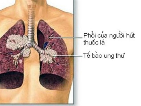 Chế độ ăn Uống, Kiêng Kị Cho Người Bị Mắc Bệnh Ung Thư Phổi