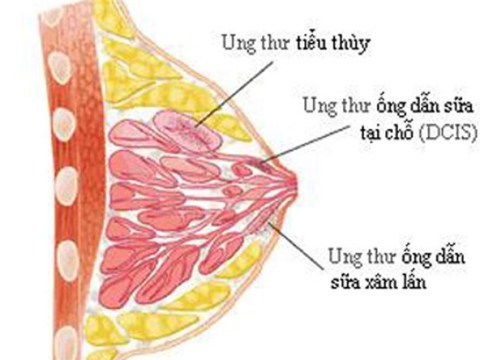 Chế độ ăn Uống, Kiêng Kị Cho Người Bị Mắc Bệnh Ung Thư Vú