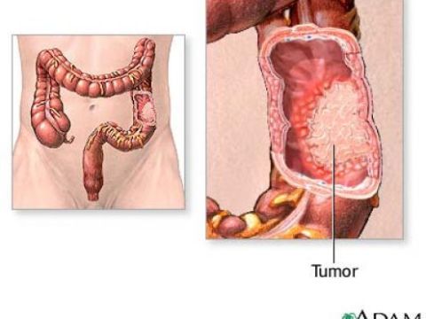 Chế độ ăn Uống, Kiêng Kị Cho Người Bị Mắc Bệnh Viêm đại Tràng